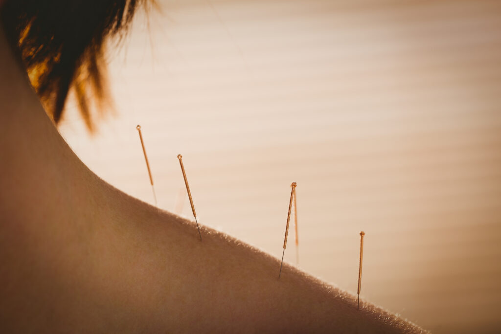 young woman getting acupuncture treatment in thera 2025 04 03 12 55 51 utc